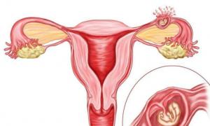 هل هناك فرصة للحمل بعد الحمل خارج الرحم؟