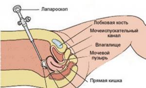 Diagnosticul laparoscopic pentru infertilitate: indicații, tehnică și recuperare