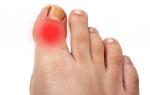 Причини и лечение на възпаление на ставата на палеца на крака