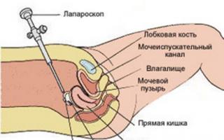Diagnostic laparoscopique de l'infertilité : indications, technique et récupération